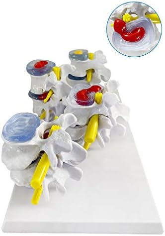 KH66ZKY LUMBAR ERTEBRAE MODEL - Медицински лумбални пршлени комбинација на нормални и патолошки модели - Алатка за медицинска обука